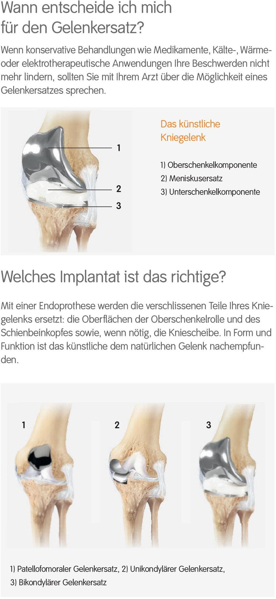 eines Gelenkersatzes sprechen. 1 2 3 Das künstliche Kniegelenk 1) Oberschenkelkomponente 2) Meniskusersatz 3) Unterschenkelkomponente Welches Implantat ist das richtige?