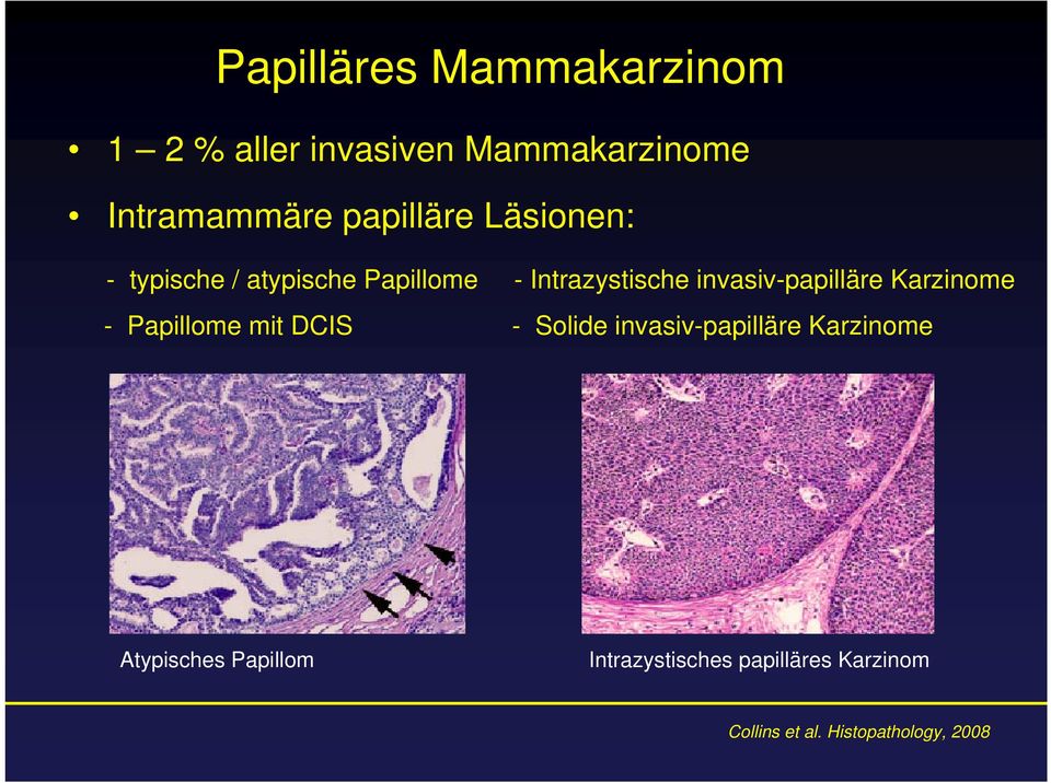 invasiv-papilläre Karzinome - Papillome mit DCIS - Solide invasiv-papilläre