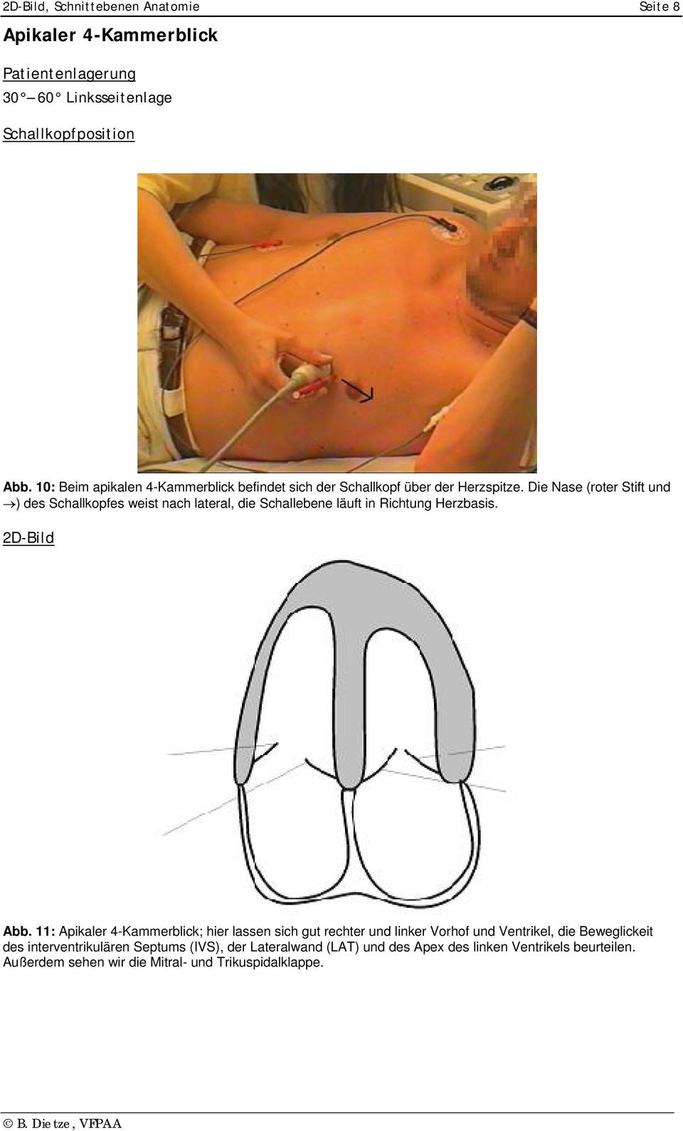 Die Nase (roter Stift und ) des Schallkopfes weist nach lateral, die Schallebene läuft in Richtung Herzbasis. 2D-Bild Abb.