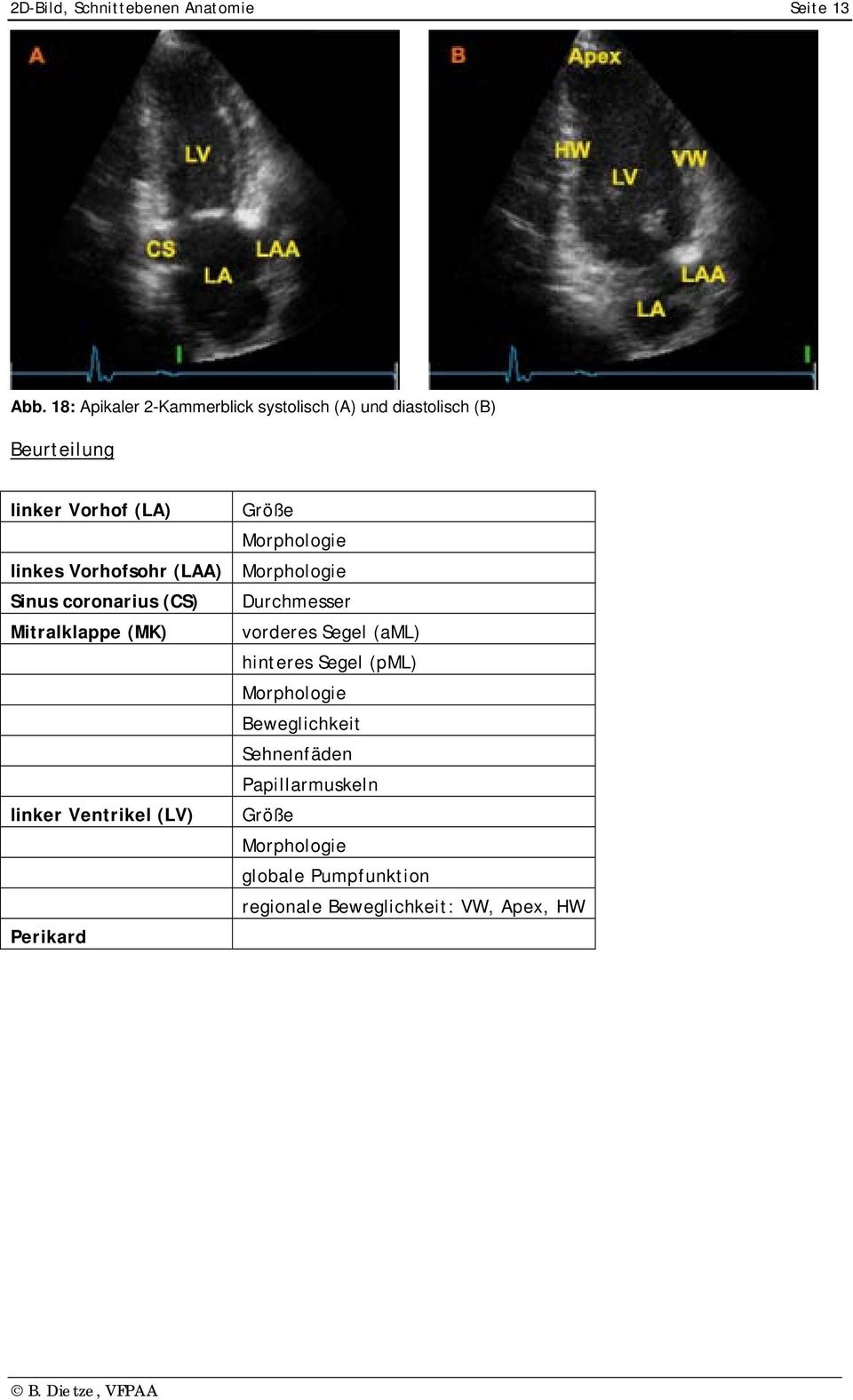 linkes Vorhofsohr (LAA) Sinus coronarius (CS) Durchmesser Mitralklappe (MK) vorderes Segel (aml)