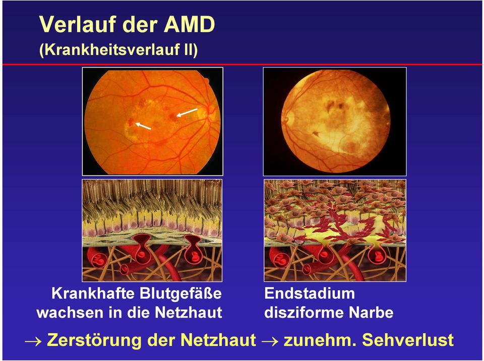 Netzhaut Endstadium disziforme Narbe