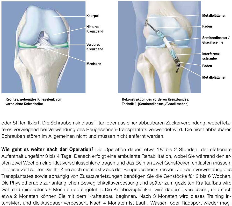 Die Schrauben sind aus Titan oder aus einer abbaubaren Zuckerverbindung, wobei letzteres vorwiegend bei Verwendung des Beugesehnen-Transplantats verwendet wird.