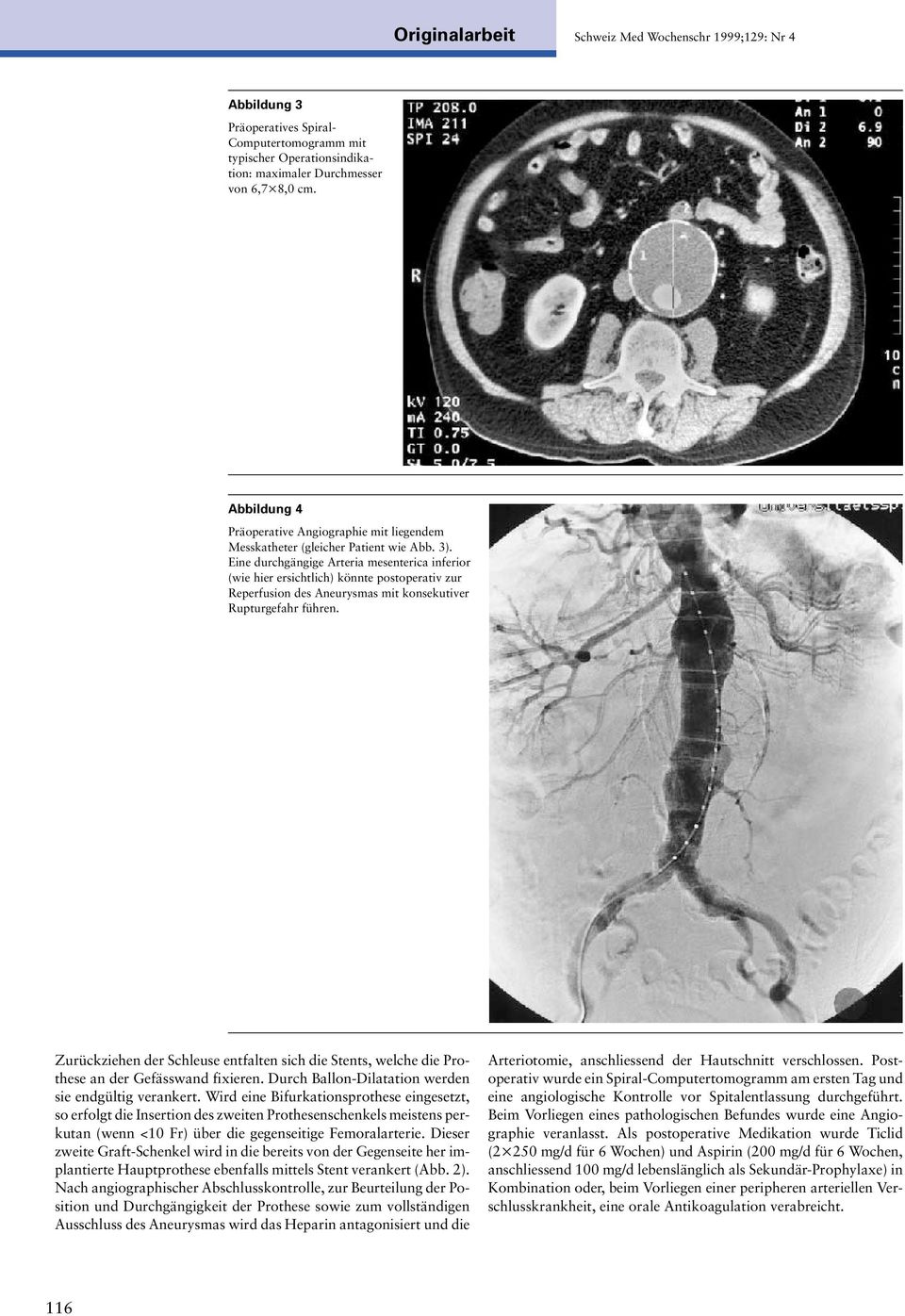 Eine durchgängige Arteria mesenterica inferior (wie hier ersichtlich) könnte postoperativ zur Reperfusion des Aneurysmas mit konsekutiver Rupturgefahr führen.