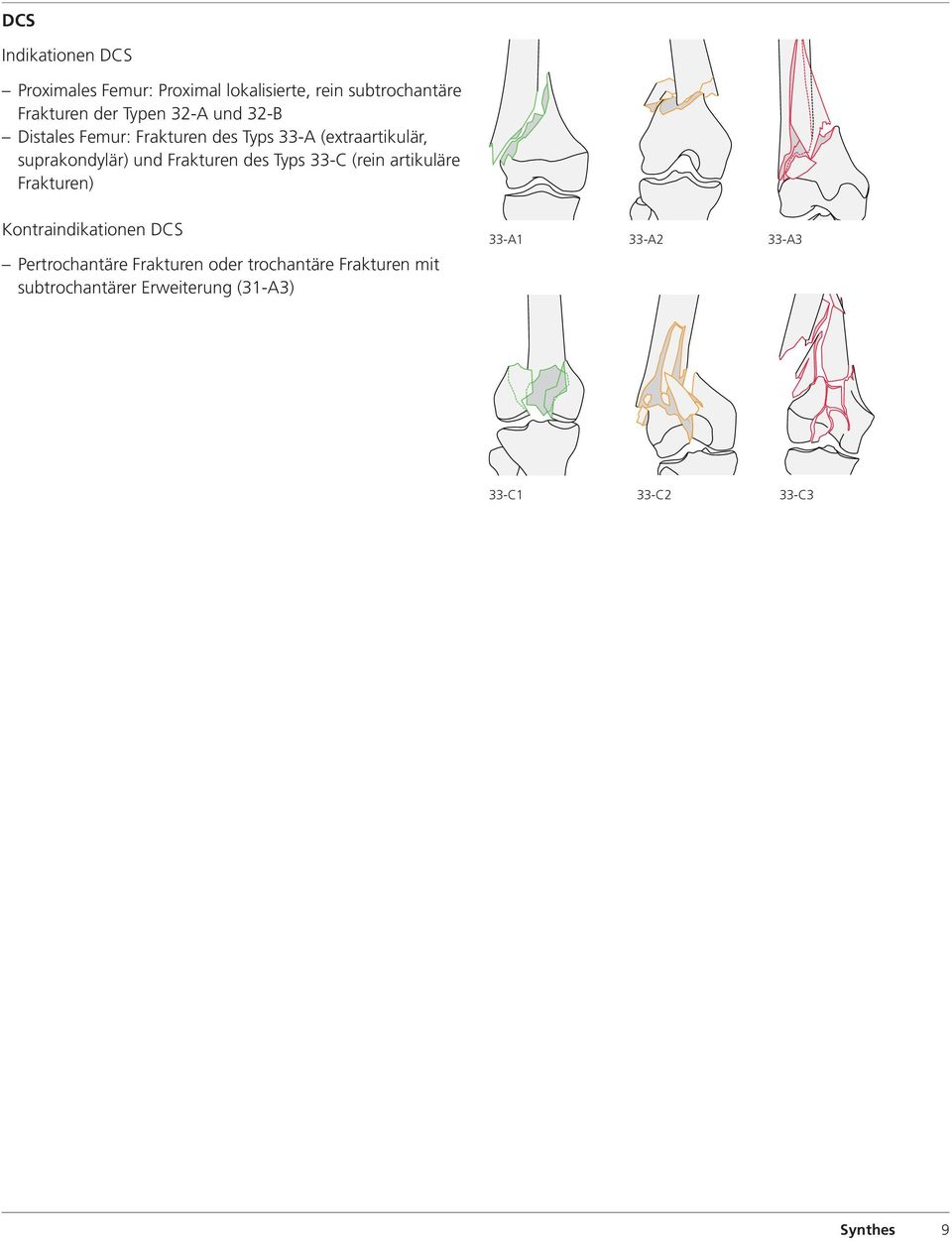 des Typs 33-C (rein artikuläre Frakturen) Kontraindikationen DCS Pertrochantäre Frakturen oder