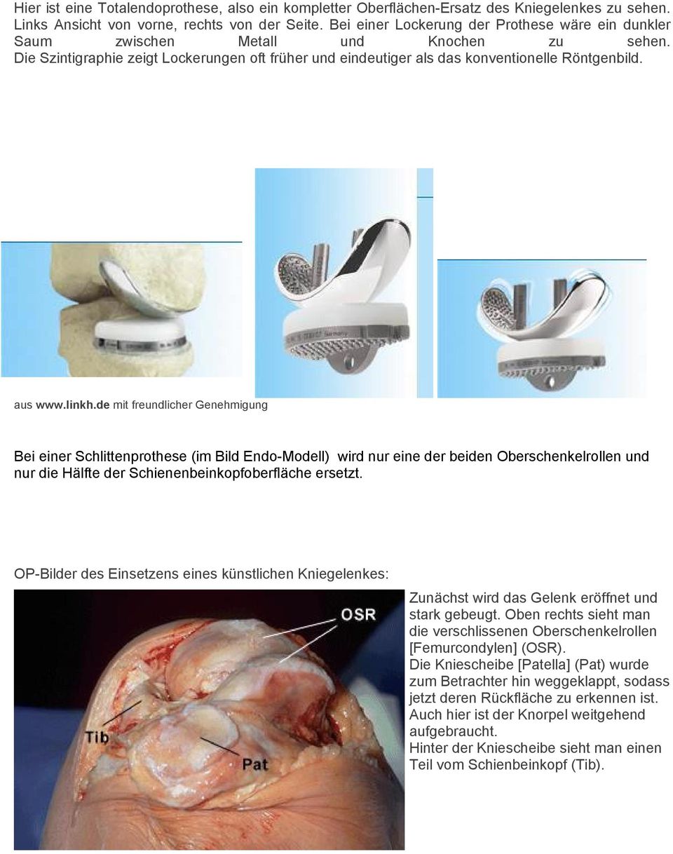 linkh.de mit freundlicher Genehmigung Bei einer Schlittenprothese (im Bild Endo-Modell) wird nur eine der beiden Oberschenkelrollen und nur die Hälfte der Schienenbeinkopfoberfläche ersetzt.