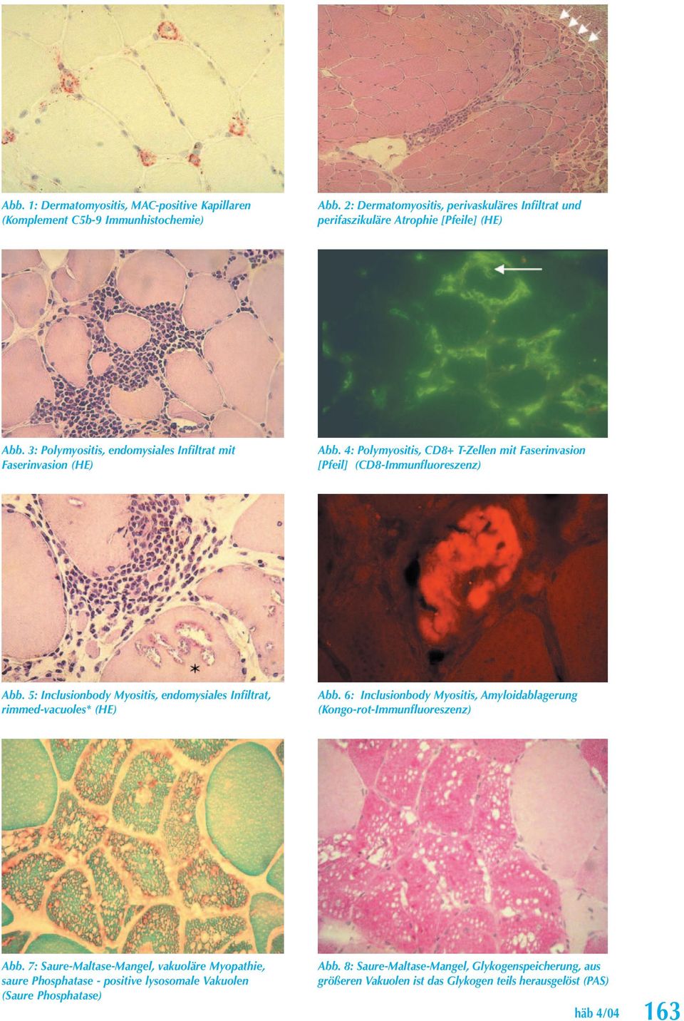 5: Inclusionbody Myositis, endomysiales Infiltrat, rimmed-vacuoles* (HE) Abb. 6: Inclusionbody Myositis, Amyloidablagerung (Kongo-rot-Immunfluoreszenz) Abb.