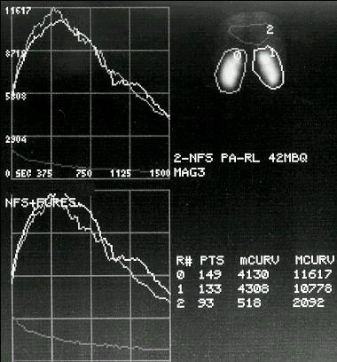 Sequenzszintigramm Diagnostik bei Nierenerkrankungen Nierensequenzszintigraphie mit 99mTc-MAG3 (Merkapto- Azetyltriglyzerin): - Beide Nieren