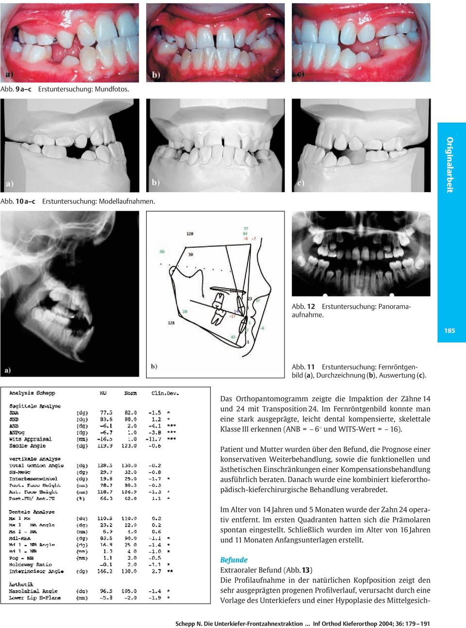 Im Fernröntgenbild konnte man eine stark ausgeprägte, leicht dental kompensierte, skelettale Klasse III erkennen (ANB = ± 68 und WITS-Wert = ± 16).