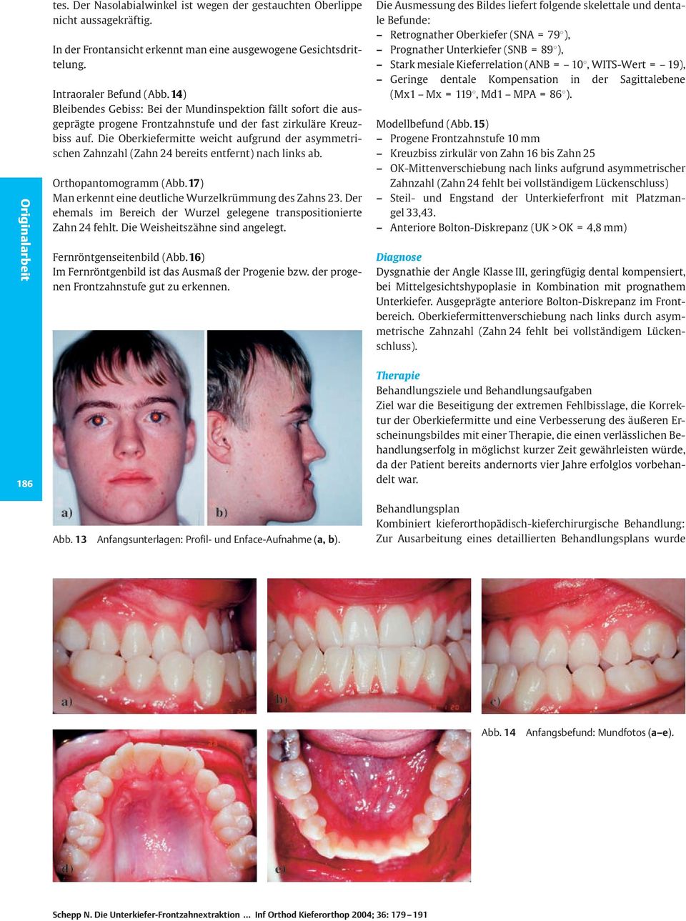 Die Oberkiefermitte weicht aufgrund der asymmetrischen Zahnzahl (Zahn 24 bereits entfernt) nach links ab. Orthopantomogramm (Abb.17) Man erkennt eine deutliche Wurzelkrümmung des Zahns 23.