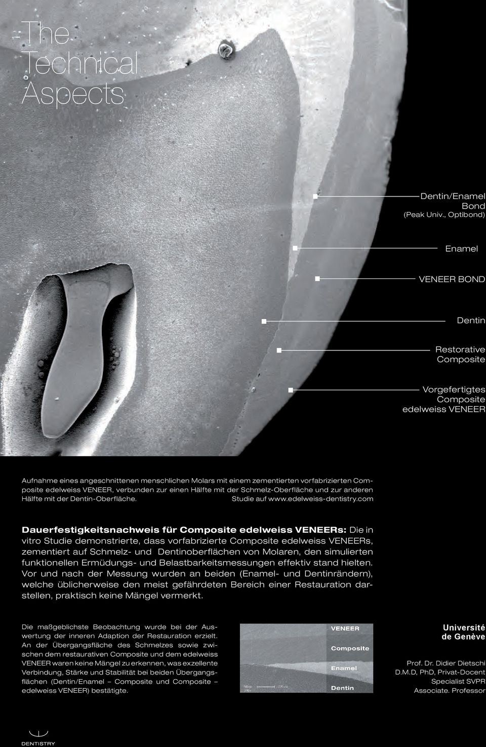 Composite edelweiss VENEER, verbunden zur einen Hälfte mit der Schmelz-Oberfläche und zur anderen Hälfte mit der Dentin-Oberfläche. Studie auf www.edelweiss-dentistry.