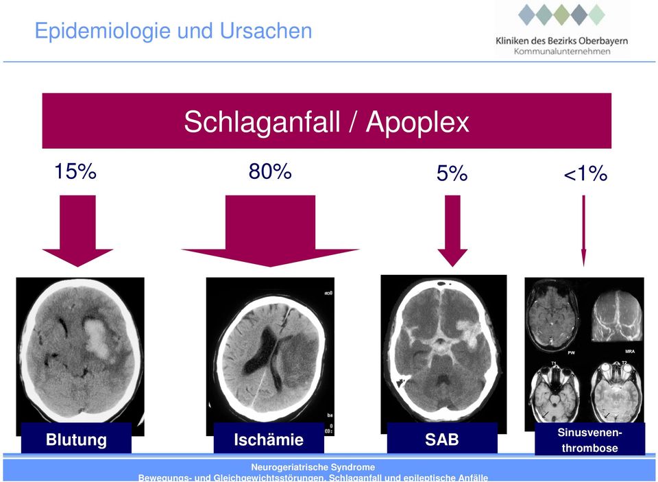 80% Blutung Ischämie 5%