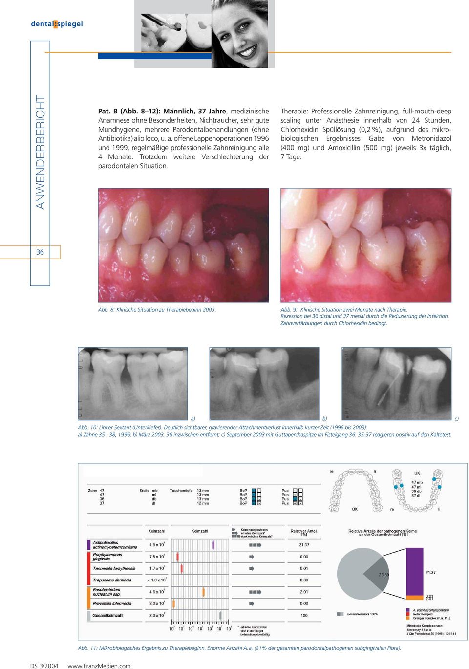 Therapie: Professionelle Zahnreinigung, full-mouth-deep scaling unter Anästhesie innerhalb von 24 Stunden, Chlorhexidin Spüllösung (0,2%), aufgrund des mikrobiologischen Ergebnisses Gabe von