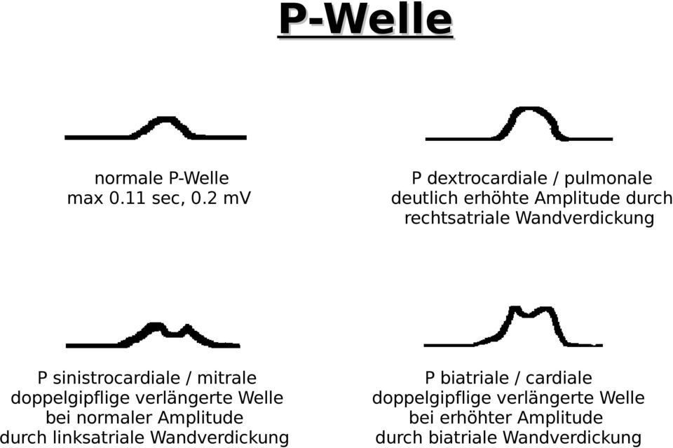 Wandverdickung P sinistrocardiale / mitrale doppelgipflige verlängerte Welle bei normaler