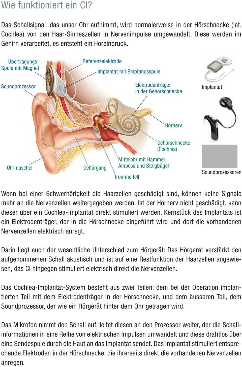 Übertragungs- Spule mit Magnet Soundprozessor Referenzelektrode Implantat mit Empfangsspule Elektrodenträger in der Gehörschnecke Implantat Hörnerv Gehörschnecke (Cochlea) Ohrmuschel Gehörgang