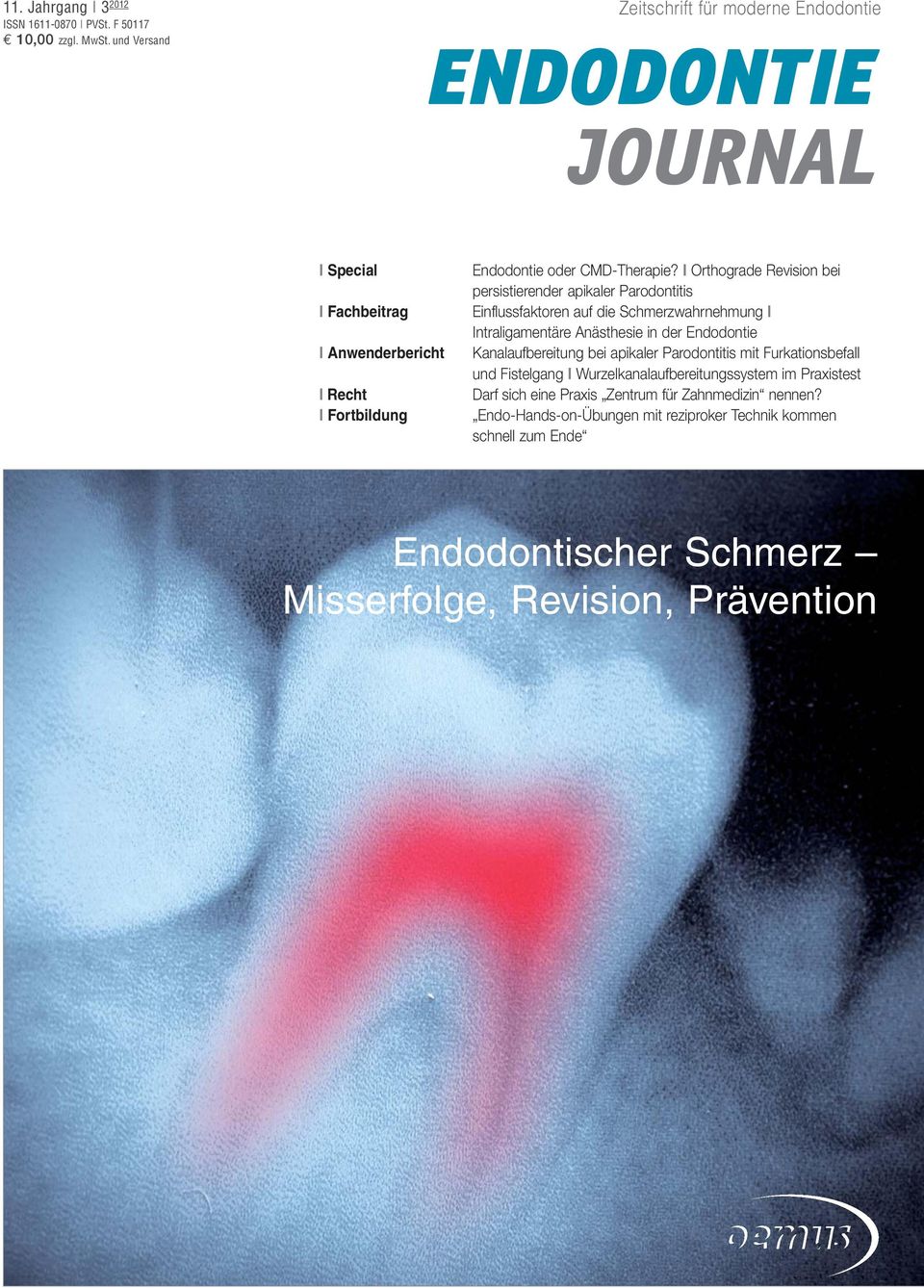 I Orthograde Revision bei persistierender apikaler Parodontitis Einflussfaktoren auf die Schmerzwahrnehmung I Intraligamentäre Anästhesie in der Endodontie