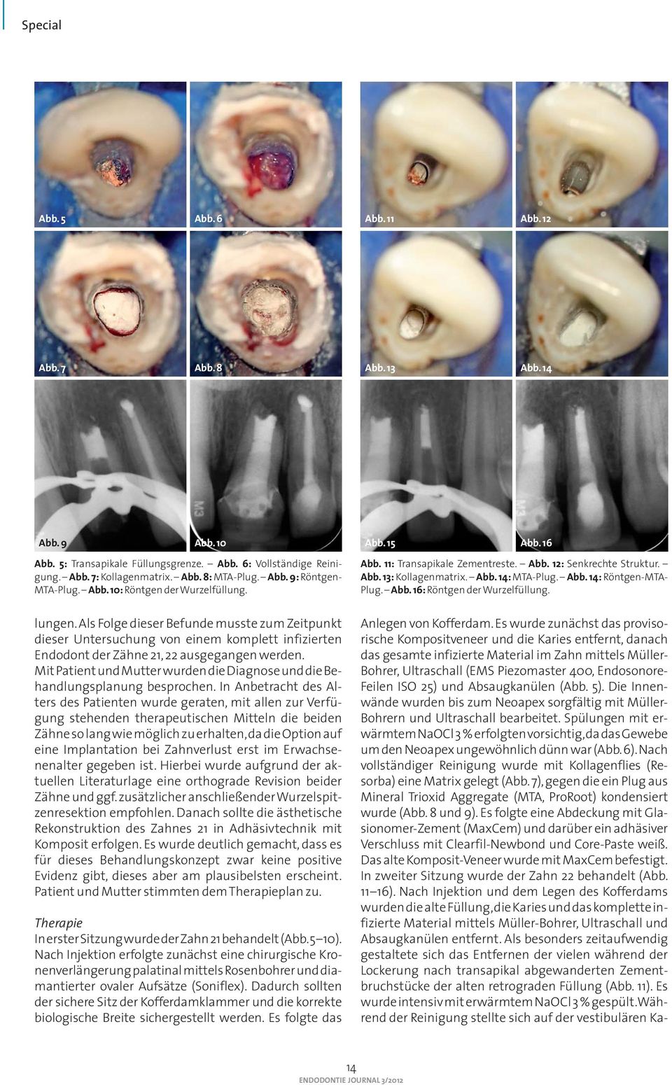 Als Folge dieser Befunde musste zum Zeitpunkt dieser Untersuchung von einem komplett infizierten Endodont der Zähne 21, 22 ausgegangen werden.