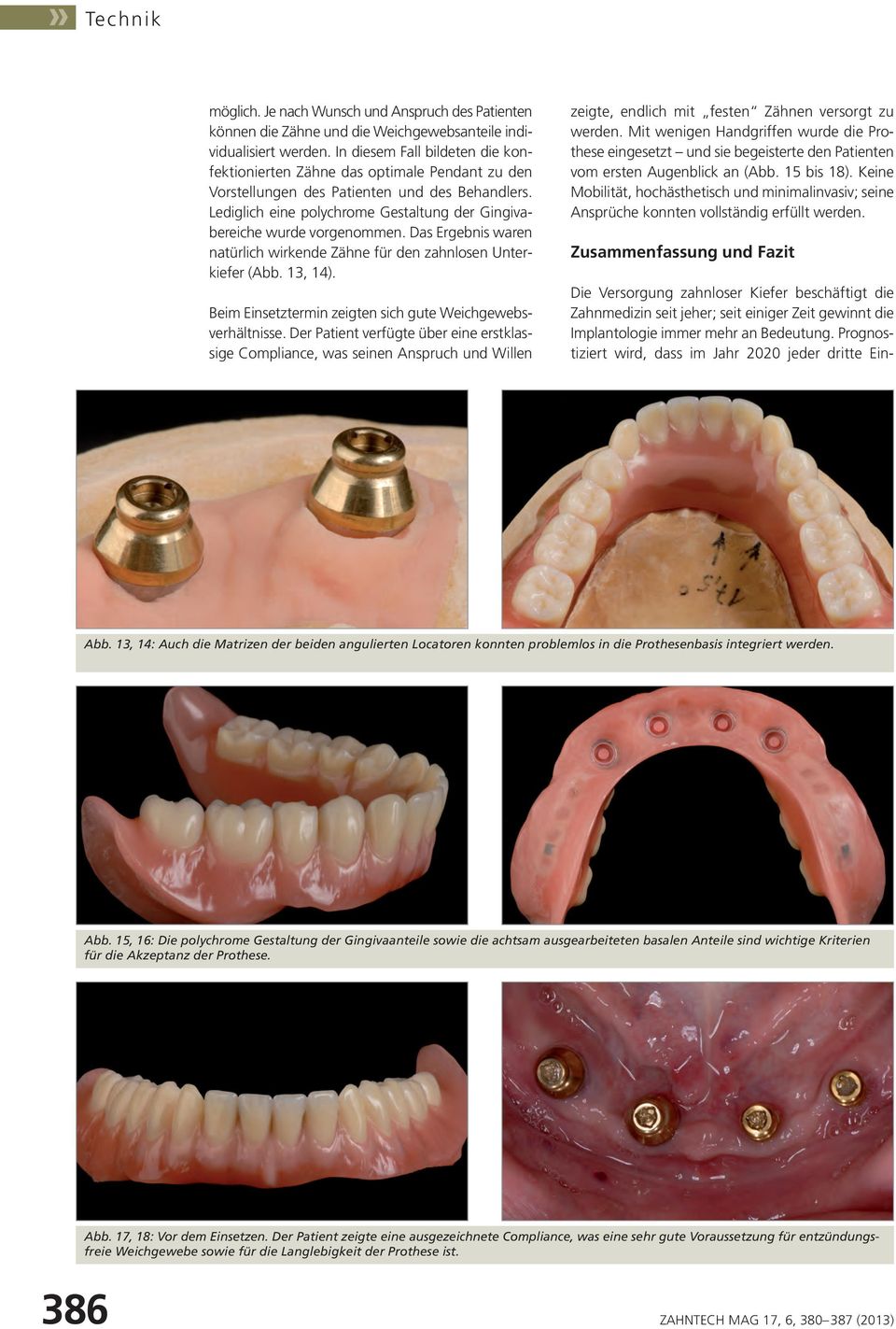 Lediglich eine polychrome Gestaltung der Gingivabereiche wurde vorgenommen. Das Ergebnis waren natürlich wirkende Zähne für den zahnlosen Unterkiefer (Abb. 13, 14).