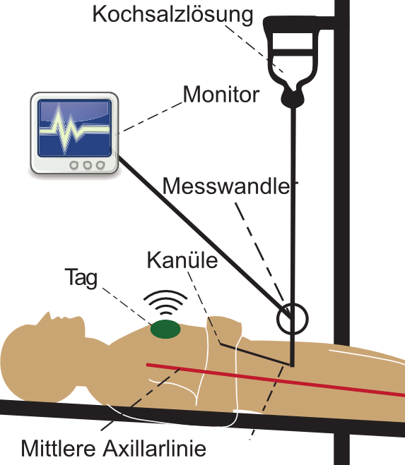 LUMEN - Lübeck Medical Engineering Blutdruck ist vitaler Parameter bei Operationen Bestimmung des Herzreferenzpunktes zur Korrektur des