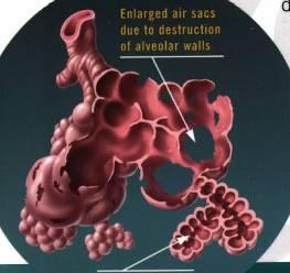 COPD (Chronic Obstructive Pulmonary Disease) = Chronisch obstruktive Bronchitis + Lungenemphysem Lungenemphysem = Zerstörung des Lungengewebes Normales Lungengewebe besteht aus vielen Millionen