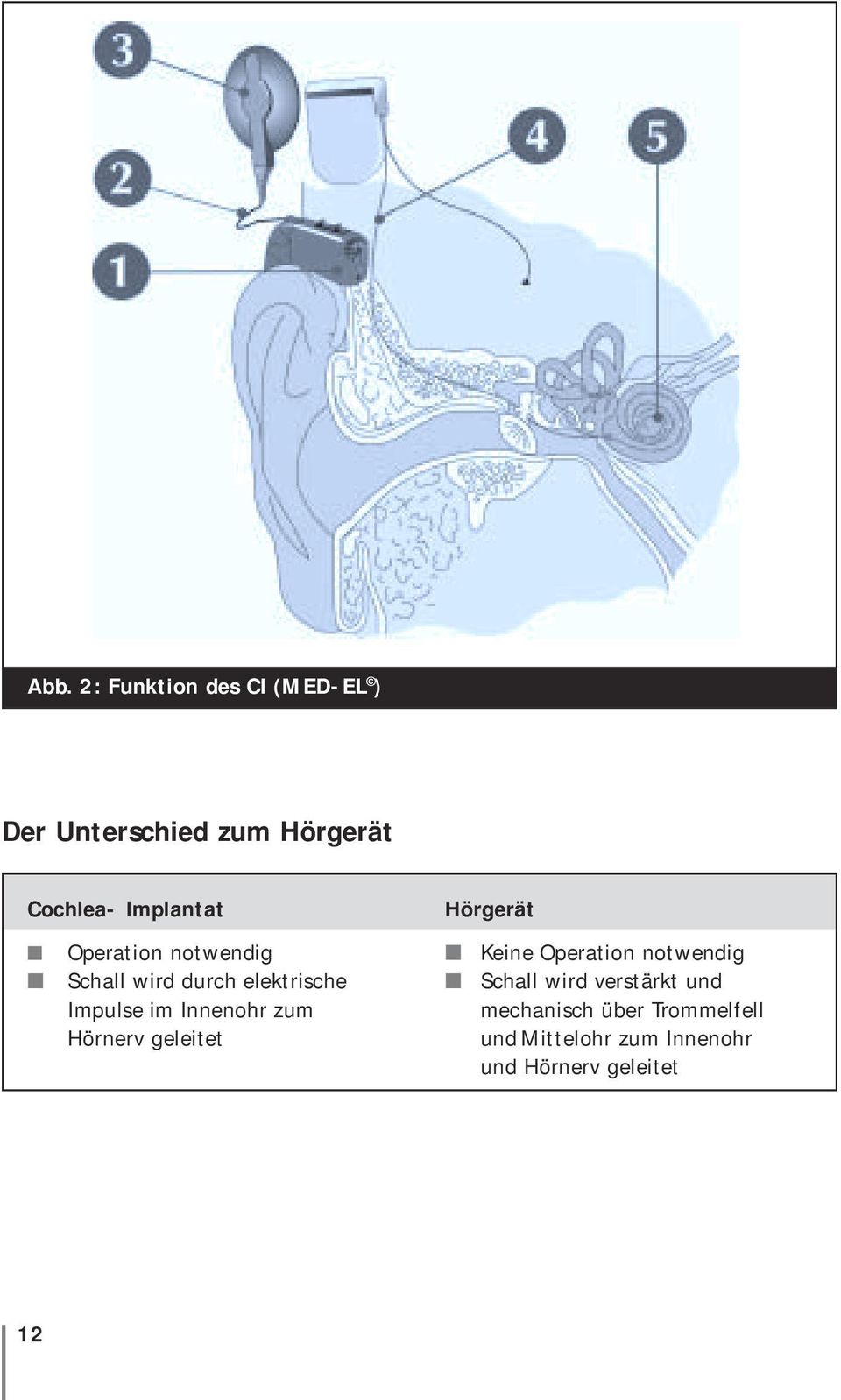 Innenohr zum Hörnerv geleitet Hörgerät Keine Operation notwendig Schall wird