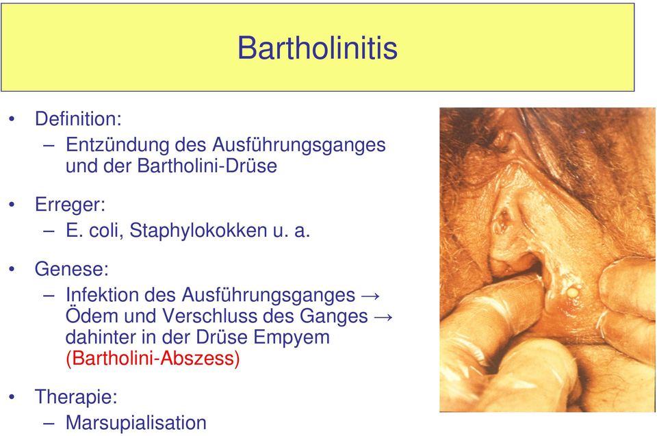 Genese: Infektion des Ausführungsganges Ödem und Verschluss des