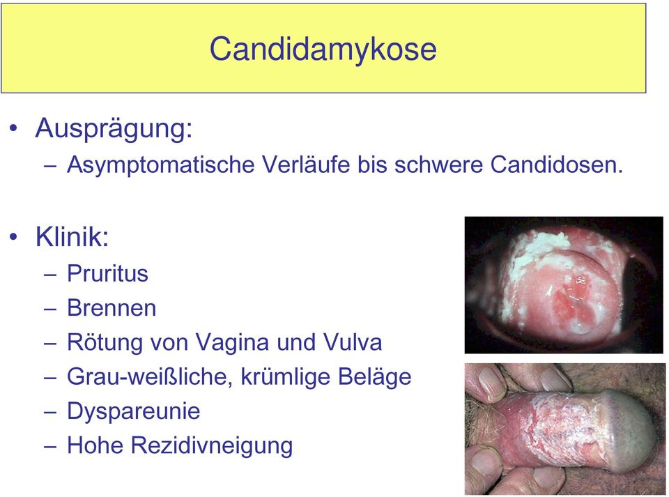 Klinik: Pruritus Brennen Rötung von Vagina und