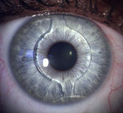 Refraktive Linsenchirurgie Einsetzen hauchdünner Kunstlinsen ( vor ) oder hinter die