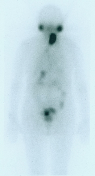 Abbildung 2: Posttherapie Scan mit Radioiod Anreicherung in der ehemaligen Schilddrüsen Loge Im Röntgen Thorax jedoch ergab sich der Verdacht auf einen Rundherd links pulmonal, woraufhin eine