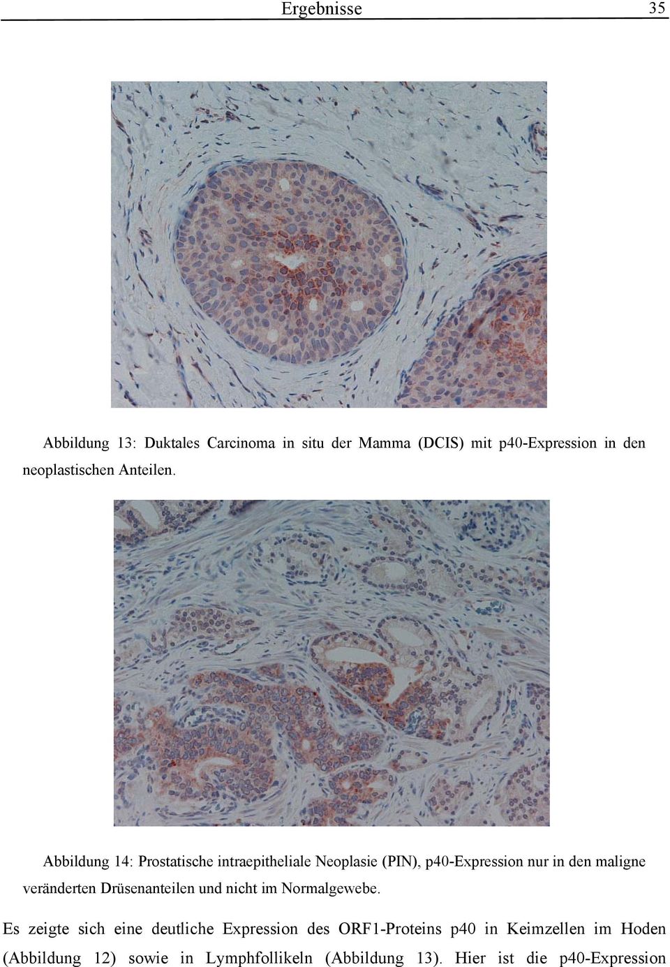 Abbildung 14: Prostatische intraepitheliale Neoplasie (PIN), p40-expression nur in den maligne veränderten