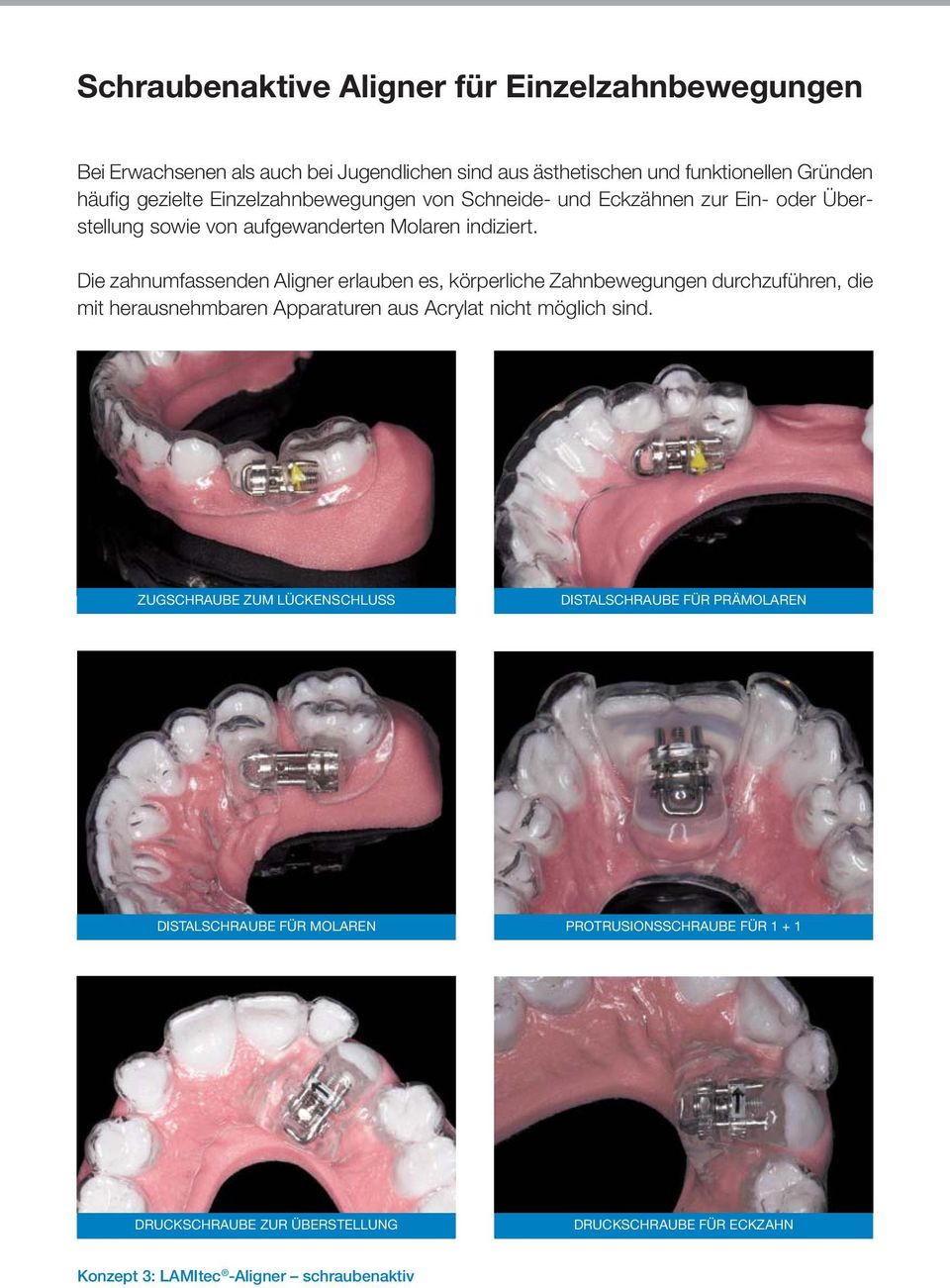 Die zahnumfassenden Aligner erlauben es, körperliche Zahnbewegungen durchzuführen, die mit herausnehmbaren Apparaturen aus Acrylat nicht möglich sind.