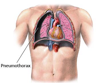 Atemmuskulatur Für die Atembewegung wichtig: «Pleura» meint allg.