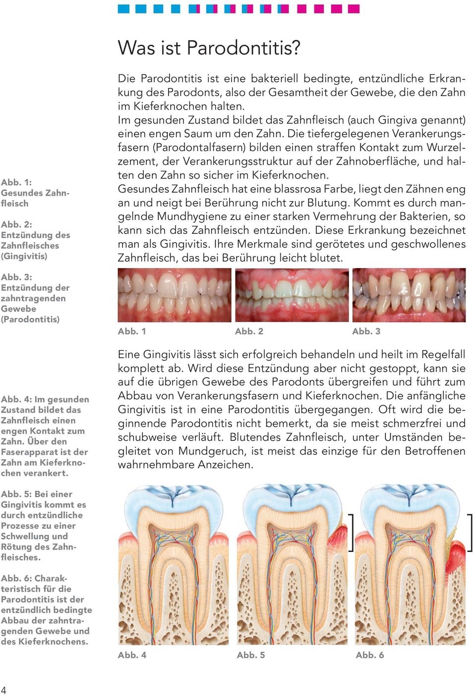 Die Parodontitis ist eine bakteriell bedingte, entzündliche Erkrankung des Parodonts, also der Gesamtheit der Gewebe, die den Zahn im Kieferknochen halten.