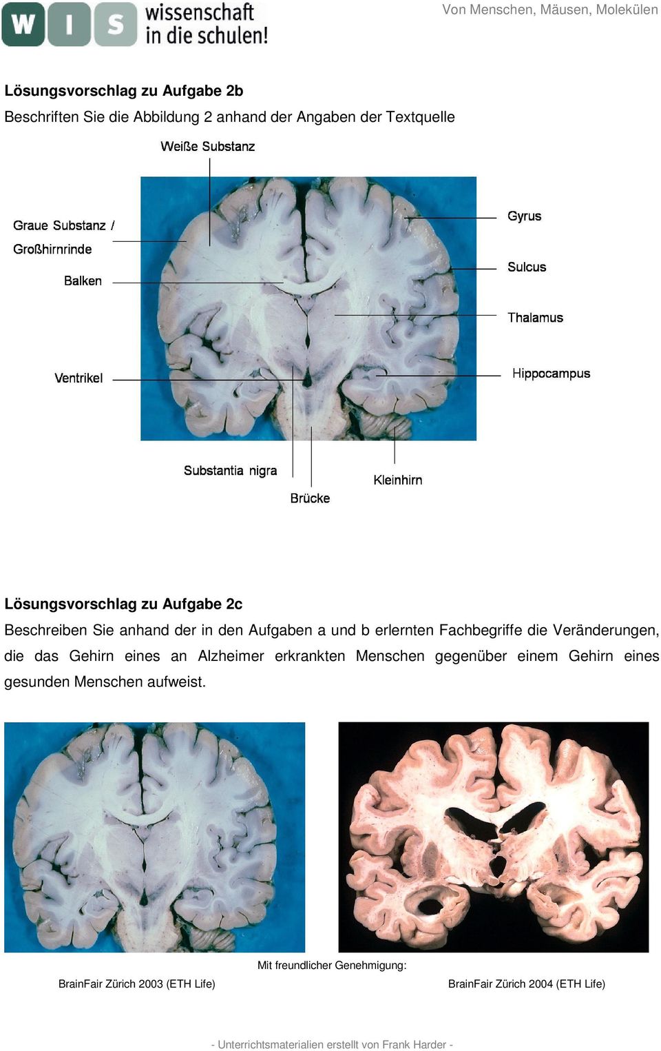die Veränderungen, die das Gehirn eines an Alzheimer erkrankten Menschen gegenüber einem Gehirn eines