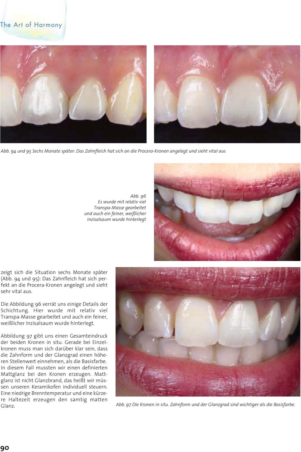 94 und 95): Das Zahnfleich hat sich perfekt an die Procera-Kronen angelegt und sieht sehr vital aus. Die Abbildung 96 verrät uns einige Details der Schichtung.