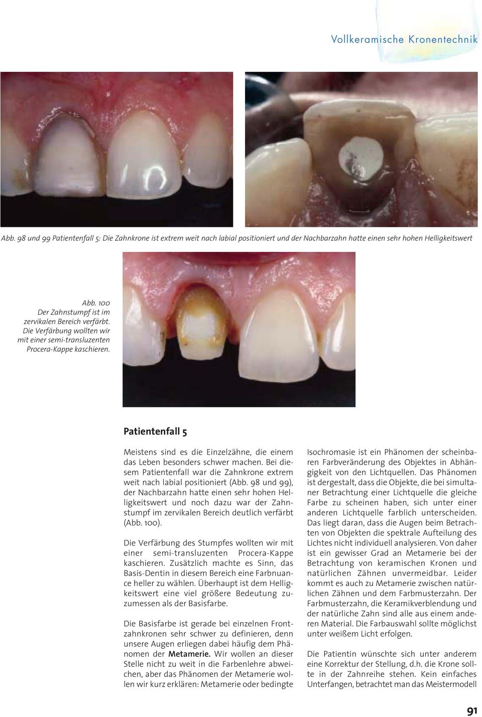 Patientenfall 5 Meistens sind es die Einzelzähne, die einem das Leben besonders schwer machen. Bei diesem Patientenfall war die Zahnkrone extrem weit nach labial positioniert (Abb.