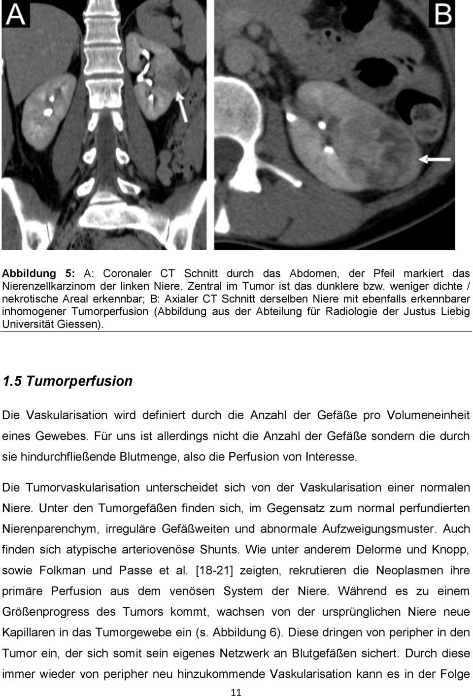 Universität Giessen). 1.5 Tumorperfusion Die Vaskularisation wird definiert durch die Anzahl der Gefäße pro Volumeneinheit eines Gewebes.