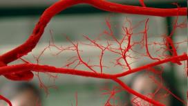 Amyloid-b Plaques Gefäßschäden Vaskuläre Demenz Alzheimer- Demenz