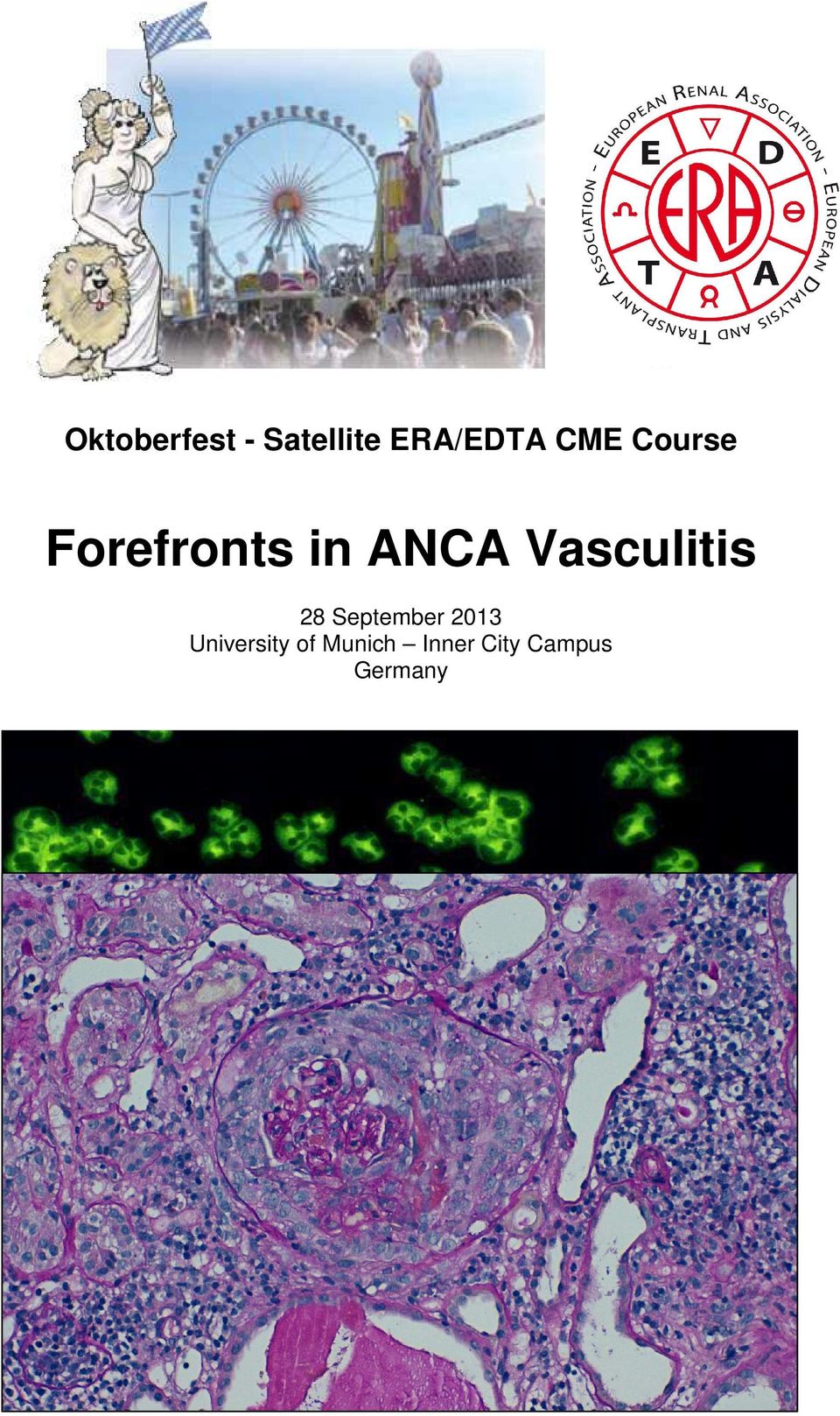 Forefronts in ANCA Vasculitis