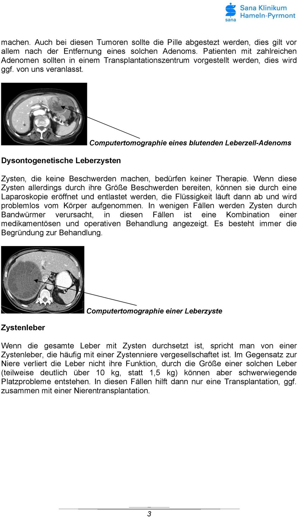 Dysontogenetische Leberzysten Computertomographie eines blutenden Leberzell-Adenoms Zysten, die keine Beschwerden machen, bedürfen keiner Therapie.
