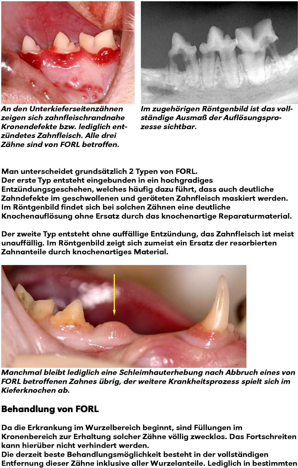 Der erste Typ entsteht eingebunden in ein hochgradiges Entzündungsgeschehen, welches häufig dazu führt, dass auch deutliche Zahndefekte im geschwollenen und geröteten Zahnfleisch maskiert werden.