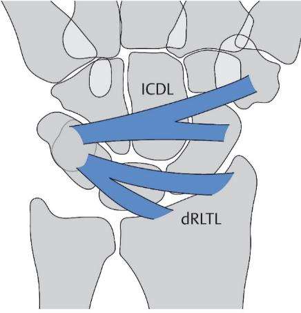 Extrinsische Bänder - Verlauf Ulnare Translokation Trauma Operation (PSR-Stylektomie) rheumatoide Arthritis Normalbefunde
