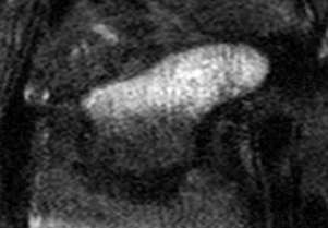 Skaphoid - Anatomie und Fraktur STT-Gelenke Tuberculum d m Taille p B2 T1 FSE fs nach Gad T1 FSE Fossa scaphoidea Gruppe Typ Frakturverlauf A = stabil B = instabil A1 A2 B1 B2