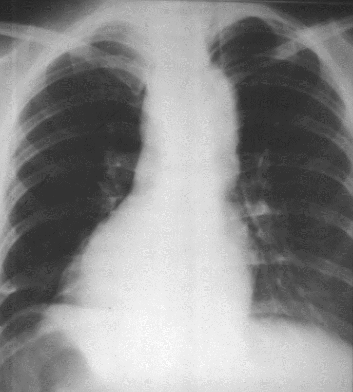 Asthma bronchiale Mastozytose Körperliche