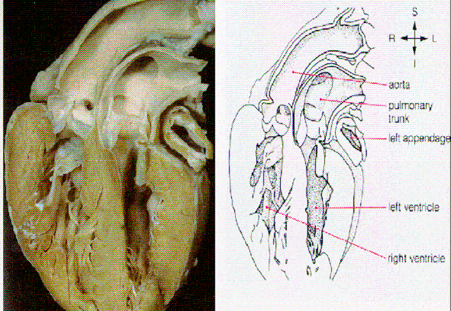 Abbildung 1: Einfache Transposition der großen Gefäße mit intaktem Ventrikelseptum s: superior, i: inferior, r: rechts, l: links, pulmonary trunk: Truncus pulmonalis, left appendage: linkes Herzohr,