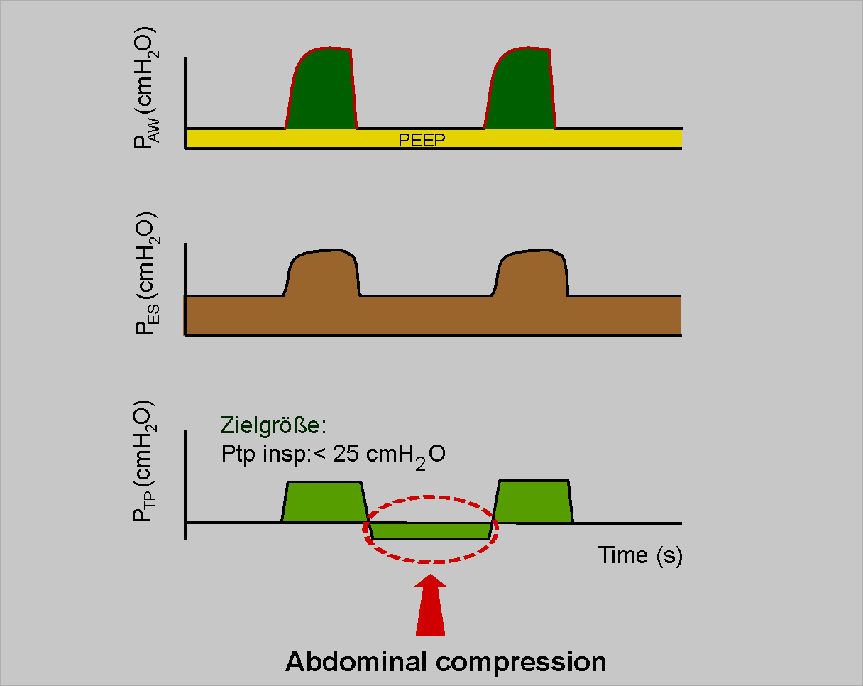 PEEP-Optimierung nach transpulmonalem Druck PEEP = 14 mbar Atelektase Atelektase Ptp negativ Ppl 17 mbar Ptp