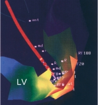 Rechts oben Fluoroskopie-Bild eines Basketkatheters mit den Elektrodenringen A-H im rechten Vorhof in rechtsschräger Position (RAO).