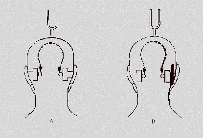 Bei einer Mittelohrerkrankung wird der Ton lateralisiert zu hören sein, bei einer Innenohrentzündung nur auf der gesunden Seite. A)gesund; B)einseitige Hörschädigung 3.