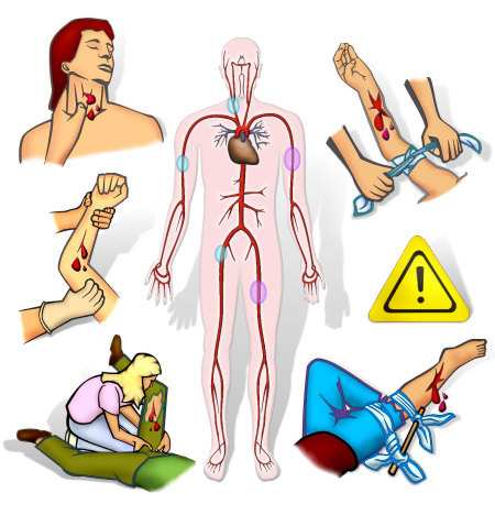 Nr. Begriff Erklärung 1 Abdrücken einer Arterie Durch Druck einer Arterie gegen einen naheliegenden Knochen kann die Blutzufuhr unterbrochen werden.
