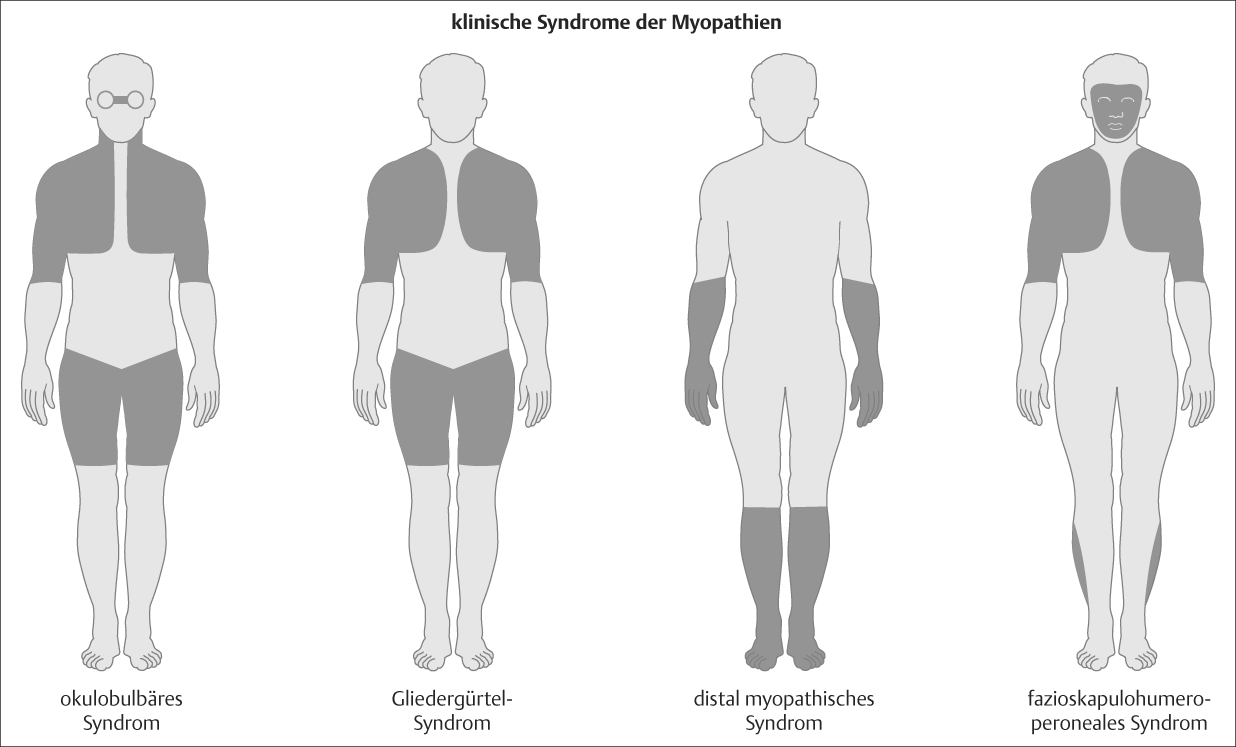 Abbildung 1 Klinische Syndrome der Myopathien (Quelle: Schoser 2009). Muskeltrophik Differenzialdiagnostische Bedeutung kommt der Frage zu, ob klinisch schwache Muskeln auch atrophisch sind.