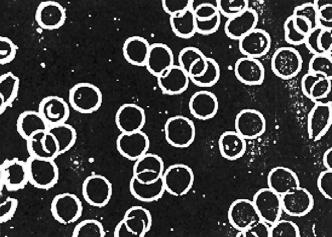 Die Bilder einer Blutprobe unter dem Dunkelfeldmikroskop zeigen: Rote Blutkörperchen (Erythrozyten) im